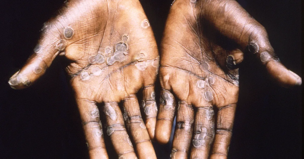 Read more about the article Africa Health Body Worried Over Monkeypox Outbreak in the EU and the US
