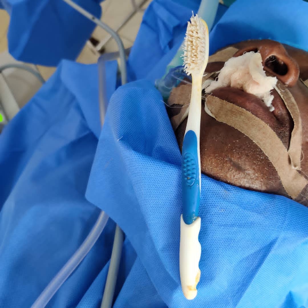 FMC Abeokuta Successfully Remove Tooth Brush Lodged In The Throat Of Patient