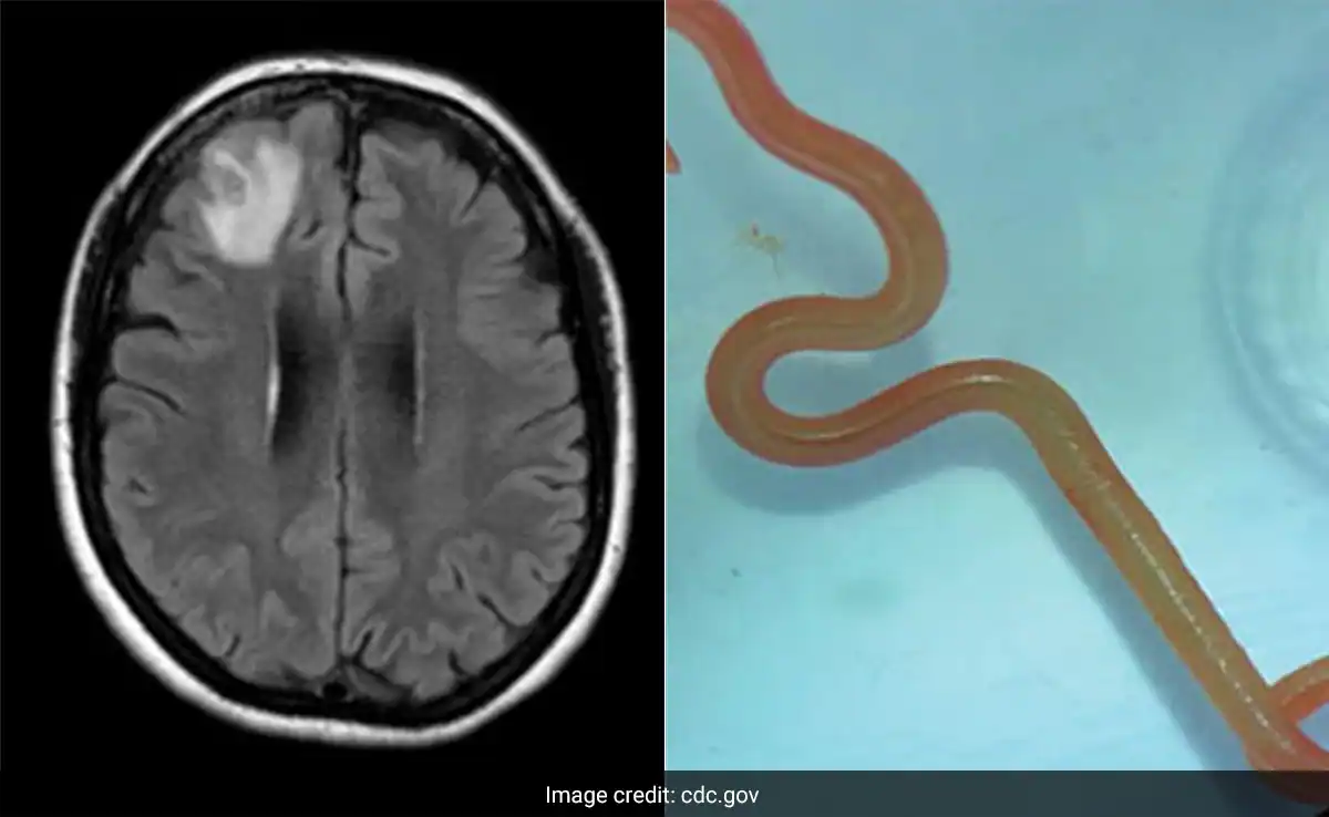 Live Worm Found in Australian Woman’s Brain in World First